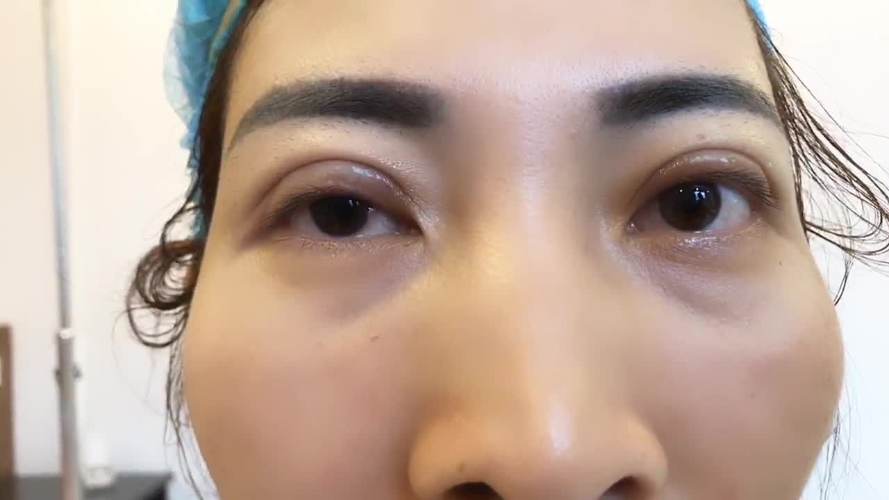 1 Ca Cắt Mí Mani Mini Deep 5D Tại Dr Hải Lê - Ca 81