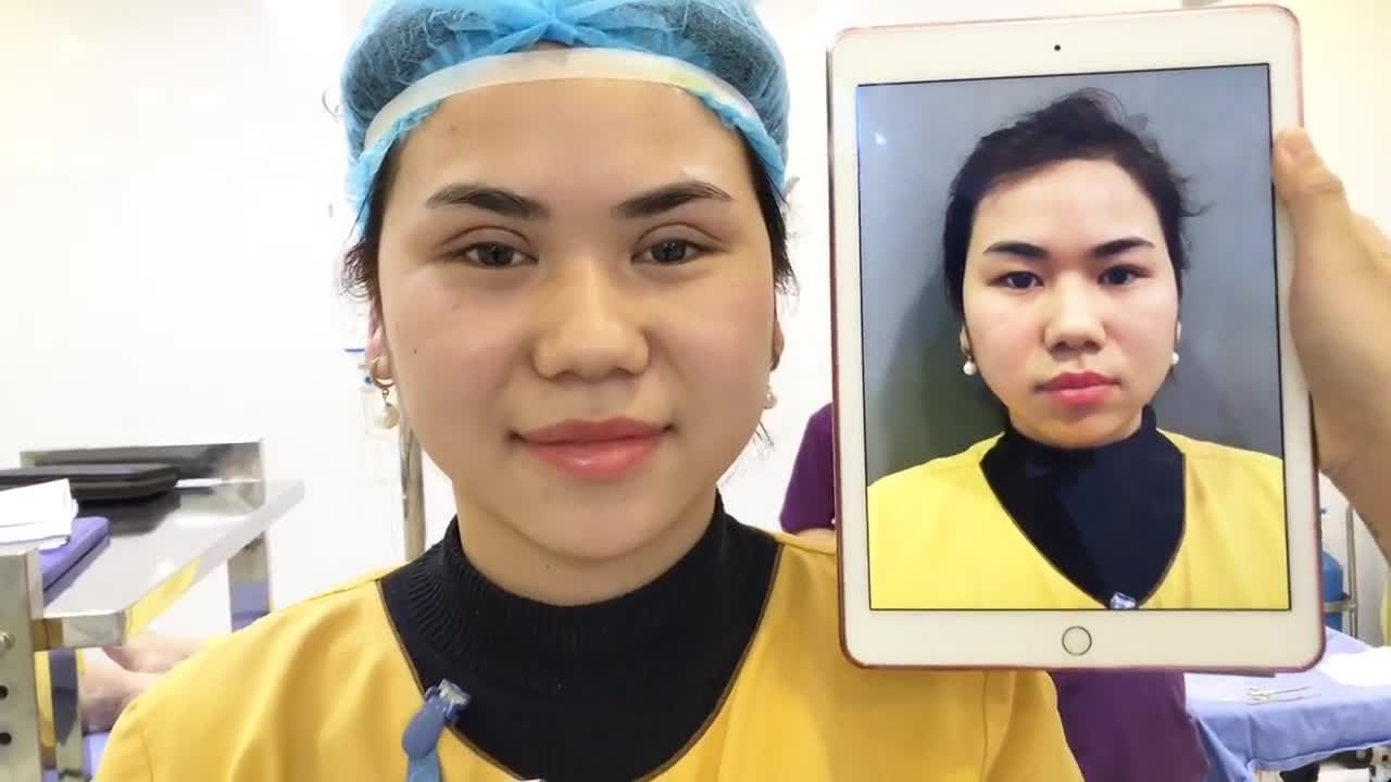 Đôi Mắt Đẹp Hoàn Hảo Sau 30 Phút Cắt Mí Mắt Tại Dr Hải Lê - Ca 92