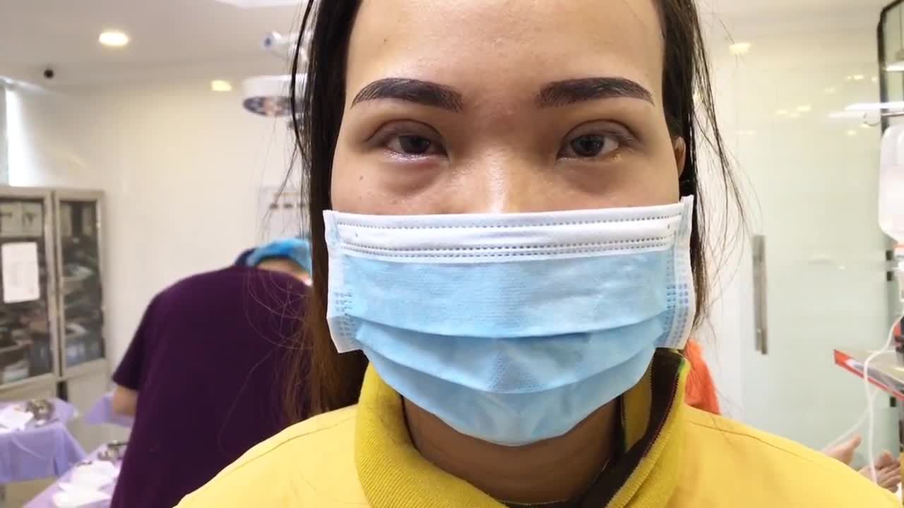 Hô Biến Đôi Mắt 1 Mí Thành Mắt 2 Mí To Tròn Sau Cắt Mí Tại Dr Hải Lê - Ca 99