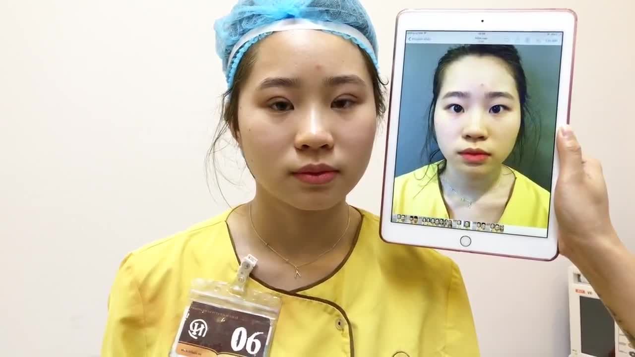 Kết Quả Cắt Mí Của Vị KH Việt Kiều Đức Đến Với Dr Hải Lê - Ca 85