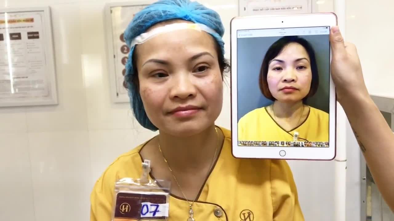Kết Quả Cắt Mí Mani Mini Deep 5D Vừa Làm Xong Tại Dr Hải Lê - Ca 90