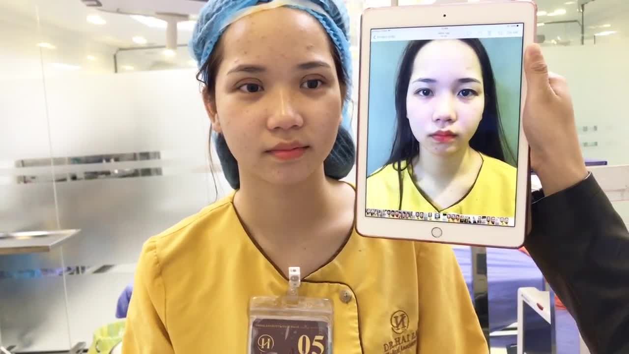 Mắt 2 Mí To Tròn Chỉ Sau 30 Phút Cắt Mí Tại Dr Hải Lê - Ca 93