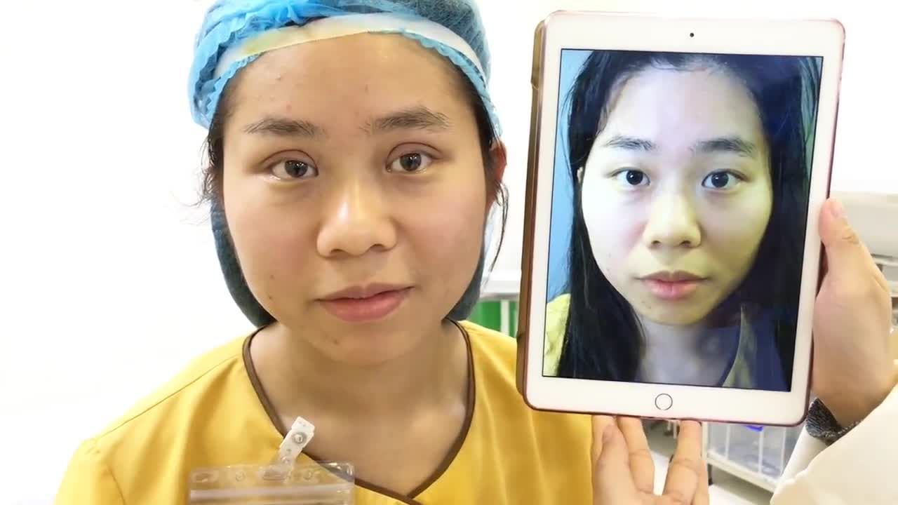 Mắt Đẹp Hoàn Hảo Sau Khi Cắt Mí Mani Mini Deep 5D Tại Dr Hải Lê - Ca 78