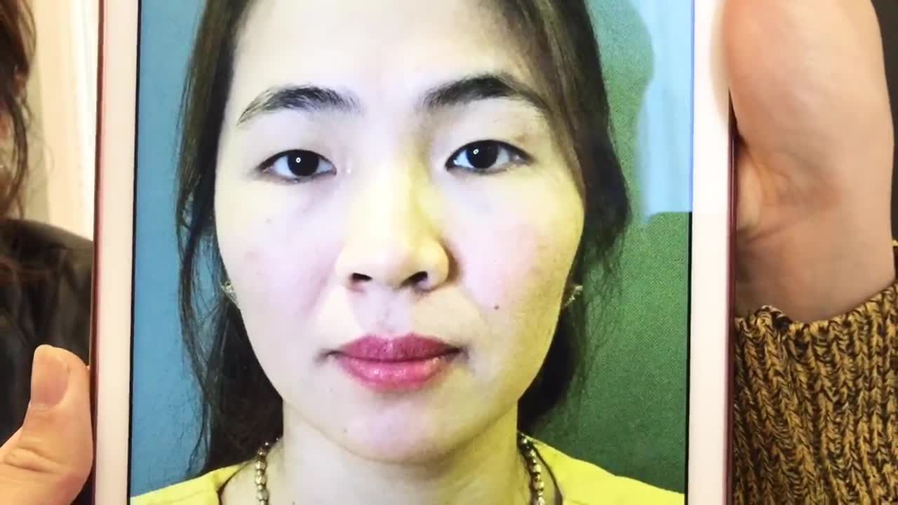 Mí Siêu Tự Nhiên Sau 8 Ngày Cắt Mí Tại Dr Hải Lê