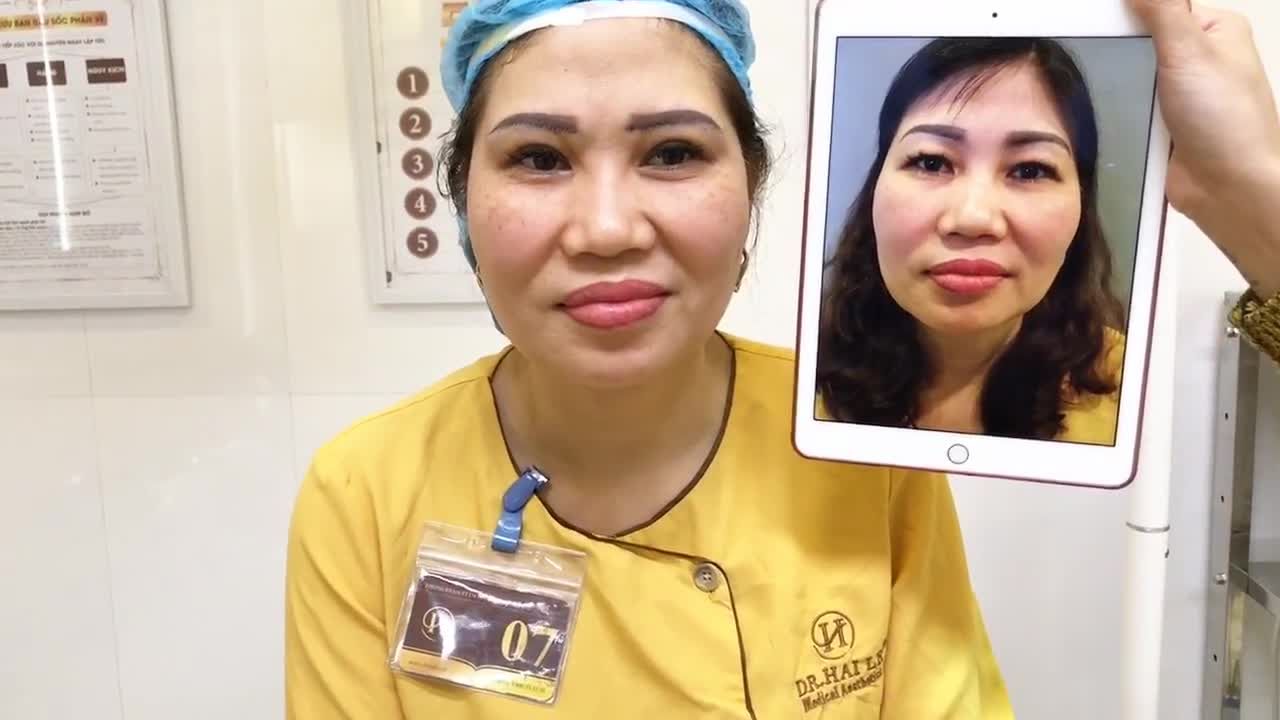Nâng Cung Mày Khắc Phục Sụp Mí Mắt Tức Thì Tại Dr Hải Lê