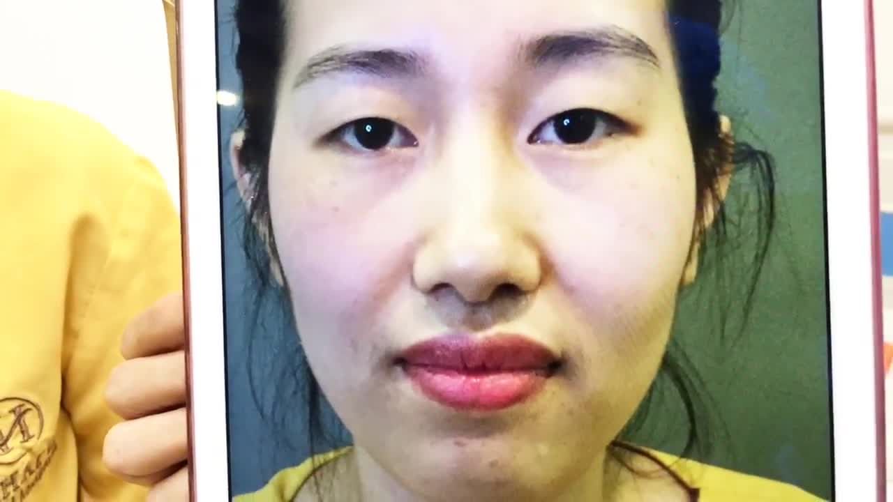 Nếp Mí Siêu Đẹp Chỉ Sau 30 Phút Cắt Mí Tại Dr Hải Lê - Ca 84