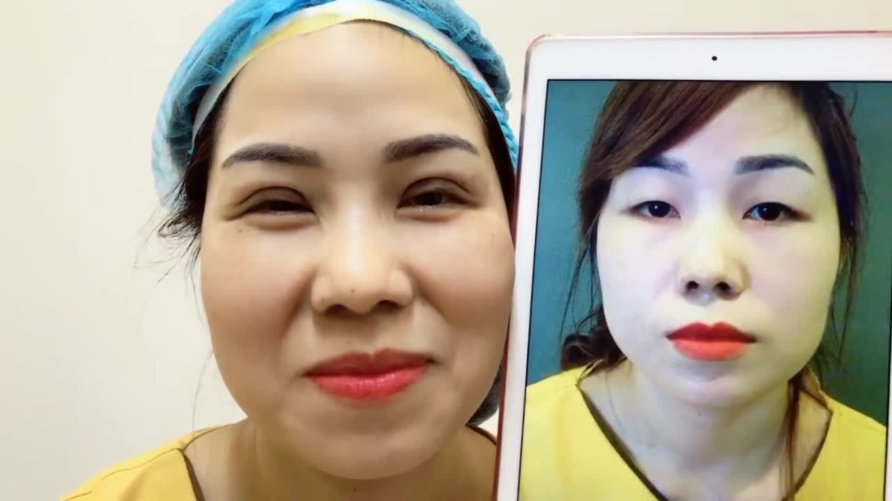 So Sánh Kết Quả Trước Sau Khi Cắt Mí Tại Dr Hải Lê - Ca 82