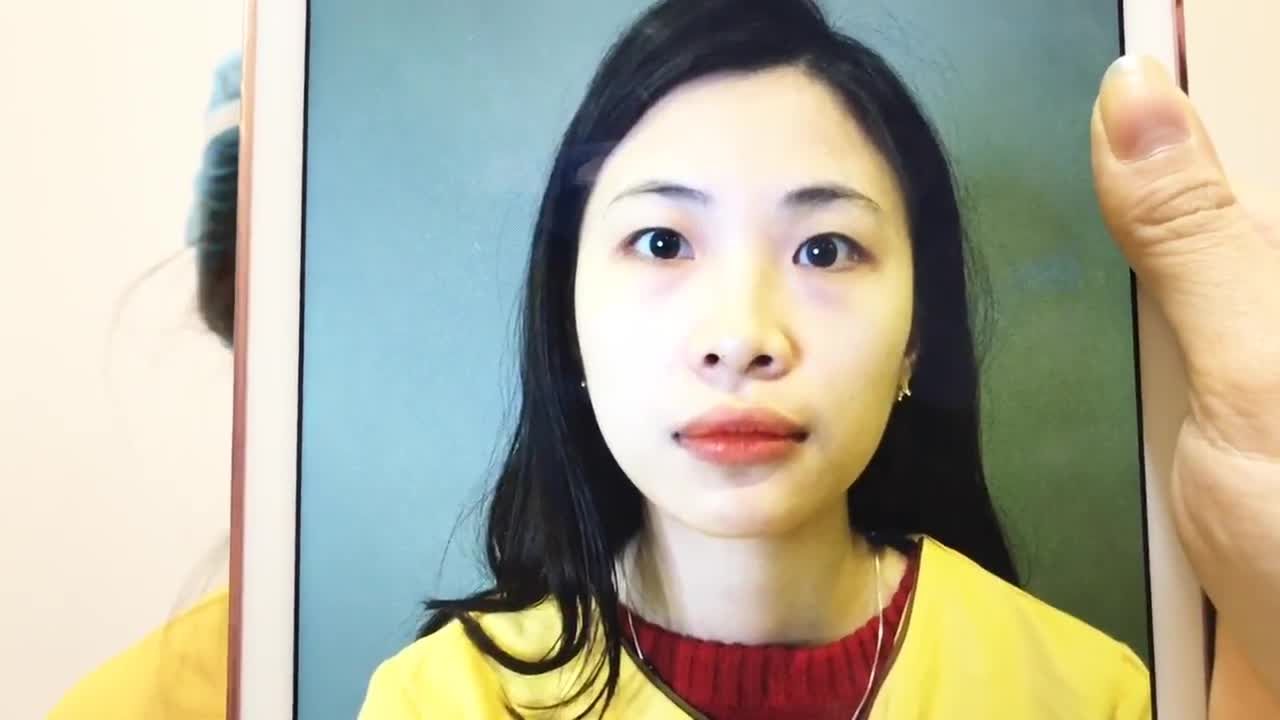Thay Đổi Đôi Mắt 1 Mí Thành Mắt 2 Mí Sau 30 Phút Cắt Mí Tại Dr Hải Lê - Ca 100