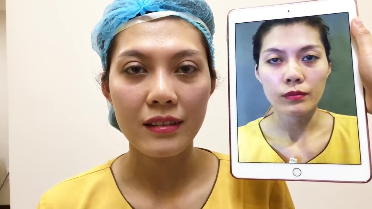 Cải Thiện Đôi Mắt Mí Lót Bằng Công Nghệ Cắt Mí Mani Mini Deep 5D - Ca 109