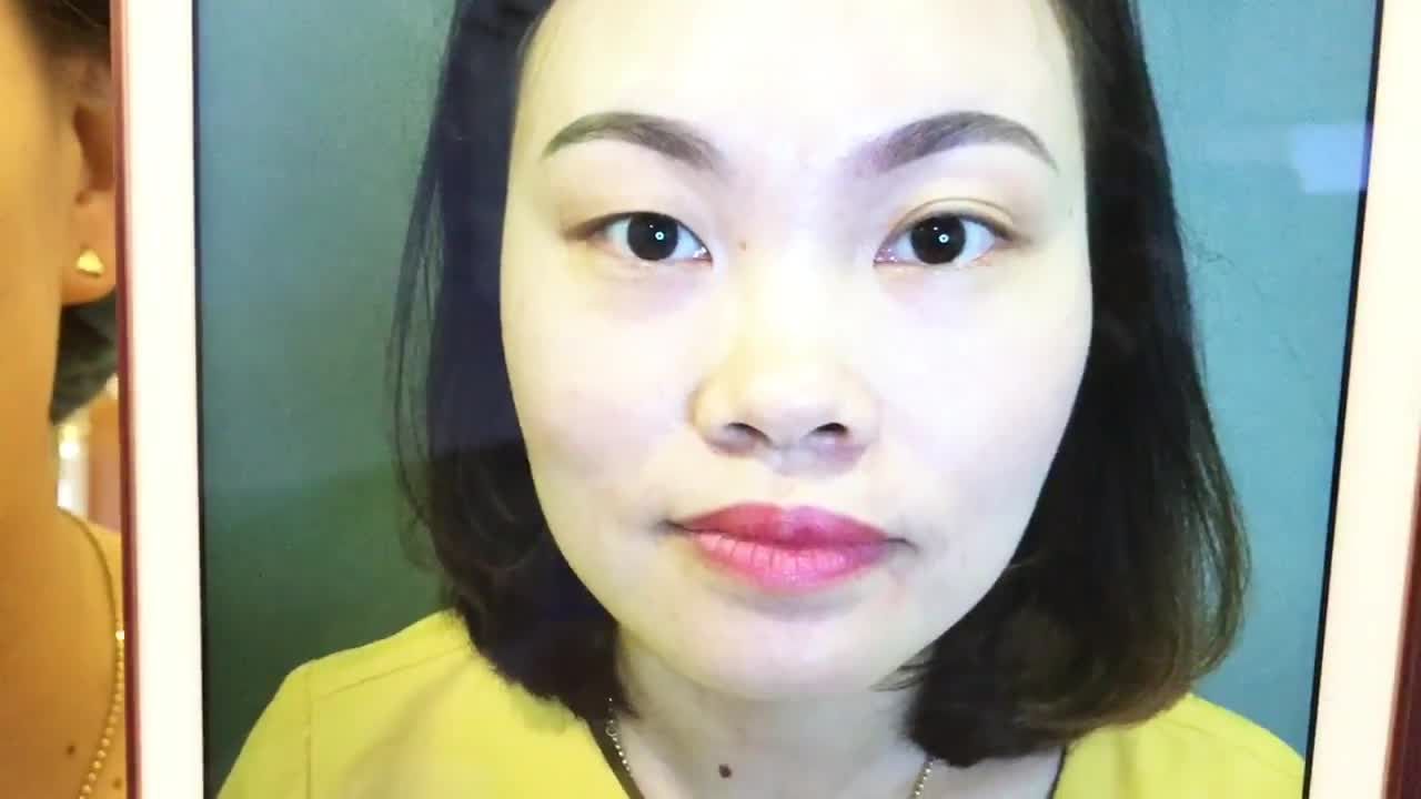 Cải Thiện Mắt To Mắt Nhỏ Bằng Cắt Mí Mắt Tại Dr Hải Lê