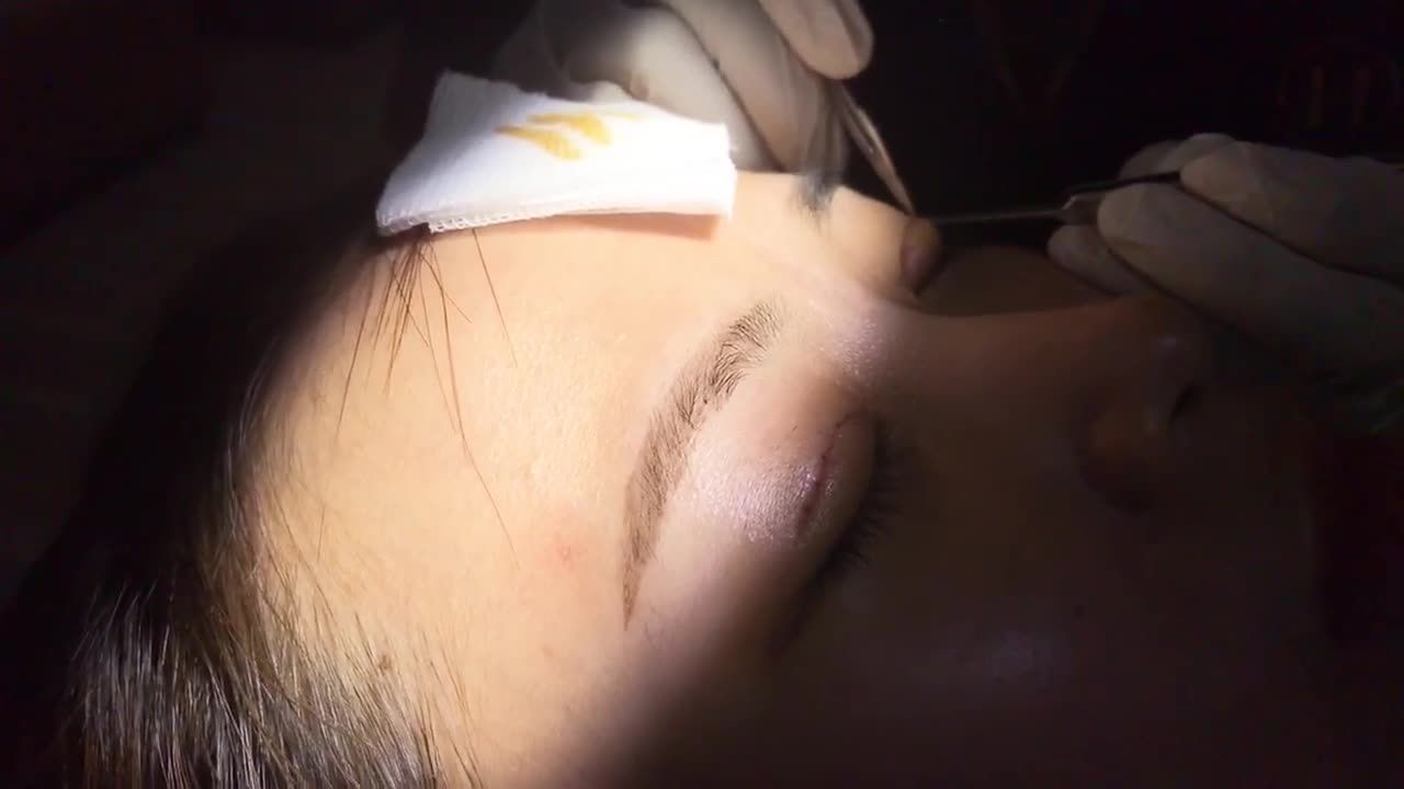 Cắt Chỉ Sau Cắt Mí Có Đau Không? Dr.Hải Lê Cam Kết Không Đau