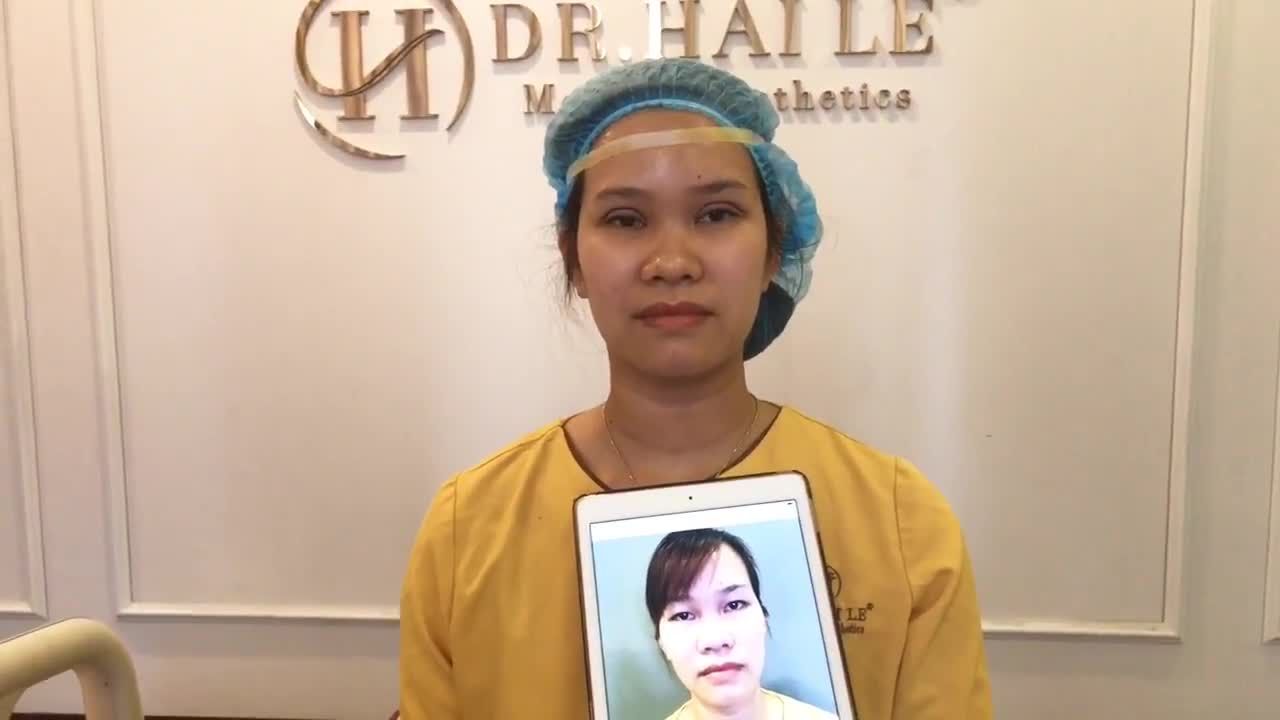 Cắt Mí Không Sưng Tím Bằng Công Nghệ Mani Open Deep 5D - Ca 172