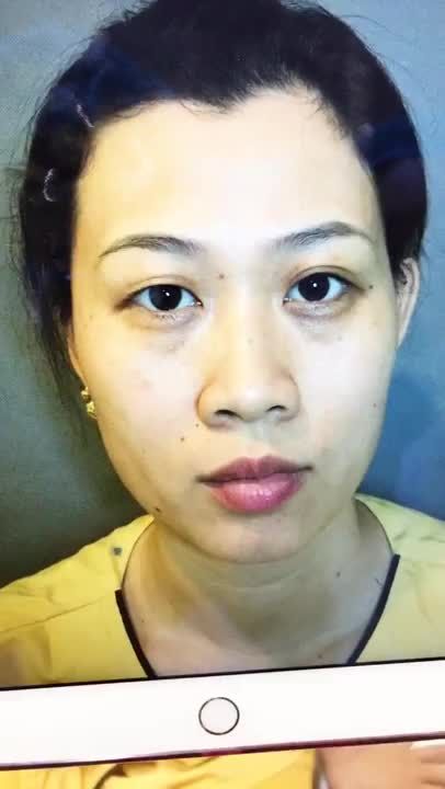 Cắt Mí Mắt Khắc Phục Đôi Mắt Lệch Mí Bẩm Sinh - Ca 249