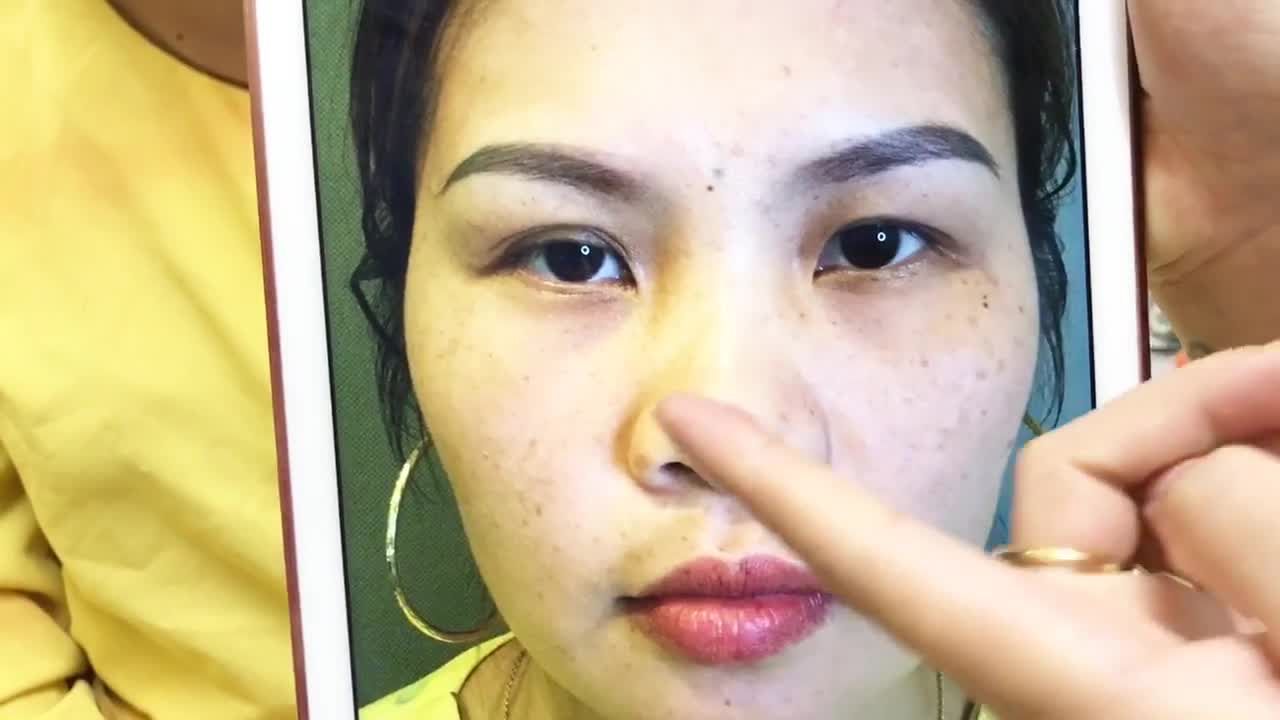 Cắt Mí Tại Dr Hải Lê Chỉ Có Đẹp Và Còn Đẹp Hoàn Hảo - Ca 238