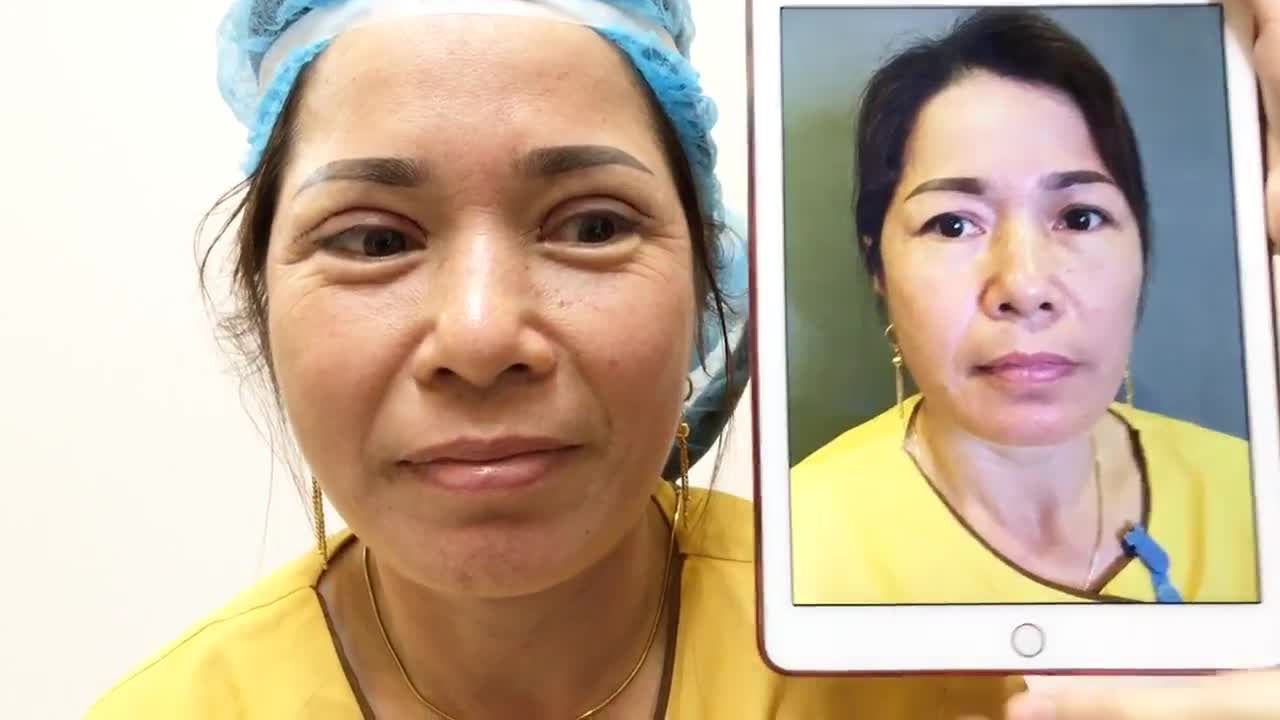 Chỉnh Đôi Mắt Sụp Mí Bằng Cắt Mí Mani Open Deep 5D Tại Dr Hải Lê - Ca 153
