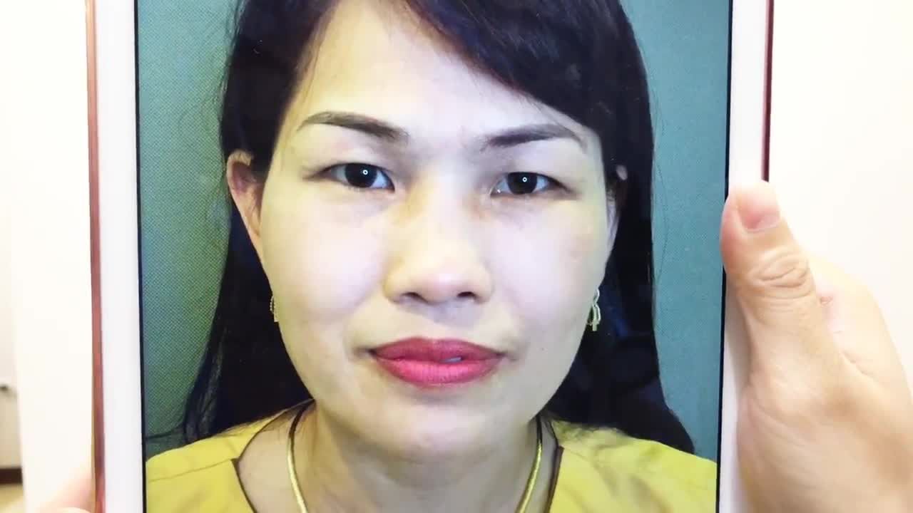 Chỉnh Mắt 1 Mí Thành Mắt 2 Mí Bằng Cắt Mí Mắt Tại Dr Hải Lê - Ca 167
