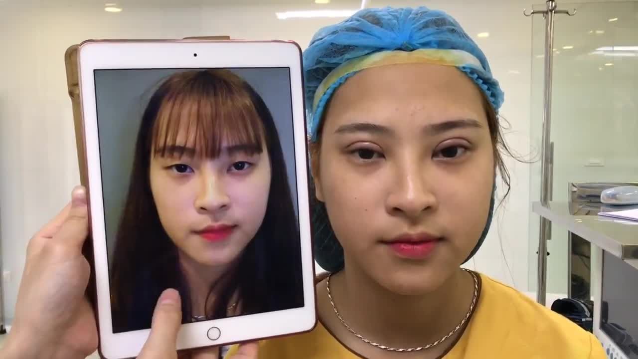 Chỉnh Mắt Ti Hí Bằng Công Nghệ Cắt Mí Mani Mini Deep 5D