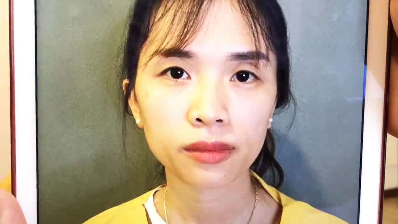 Chỉnh Sửa Đôi Mắt 1 Mí Thành 2 Mí To Tròn Tự Nhiên Tại Dr Hải Lê - Ca 235