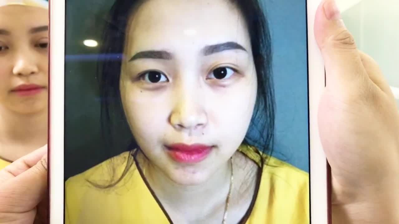 Chỉnh Sửa Đôi Mắt 2 Nếp Mí Lệch Nhau Tại Dr Hải Lê - Ca 229