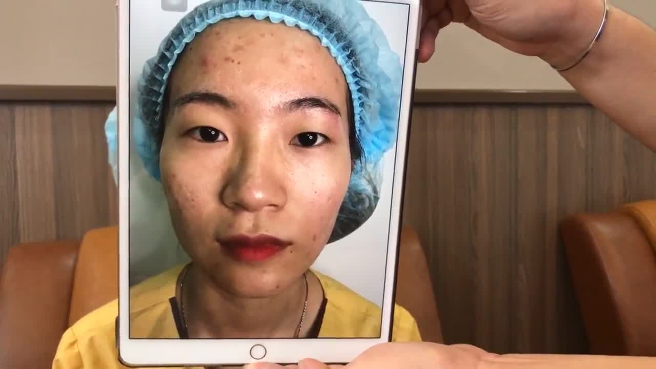 Chỉnh Sửa Mắt 1 Mí Thành 2 Mí Trong Tích Tắc Khi Cắt Mí Tại Hải Lê - Ca 187