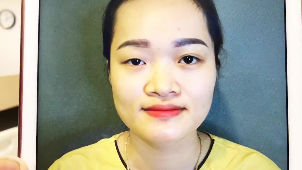 Chỉnh Sửa Mắt So Le Bằng Phương Pháp Cắt Mí Mắt Tại Dr Hải Lê - Ca 230