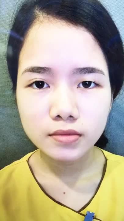 Chỉnh Sửa Mắt To Mắt Bé Bằng Cắt Mí Mắt Tại Dr Hải Lê - Ca 178