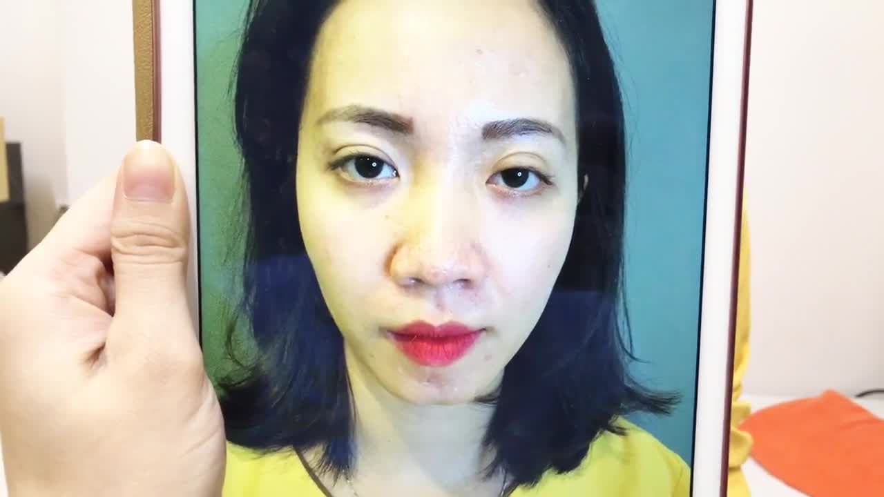 Chữa Sụp Mí Bẩm Sinh Bằng Kỹ Thuật Cắt Mí Tại Dr Hải Lê