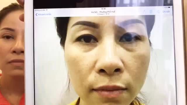Cùng Nhận Xét Nếp Mí Mới Sau 7 Ngày Cắt Mí Tại Dr Hải Lê