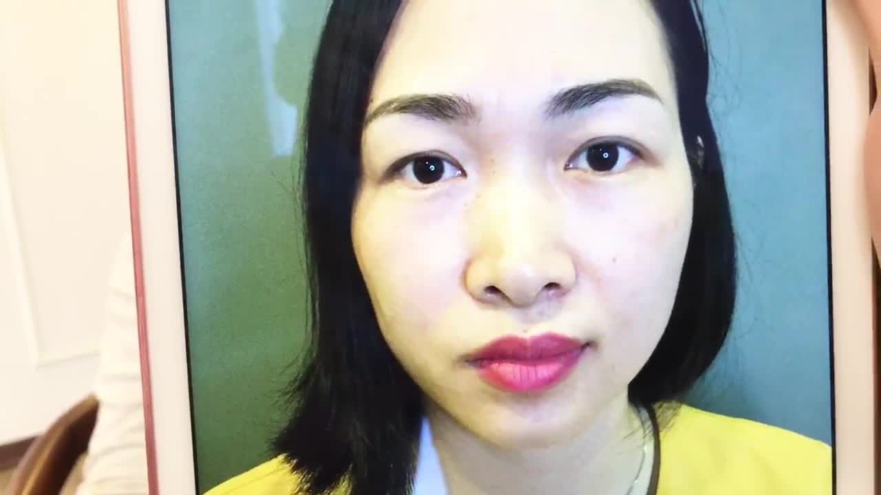 Cùng Tham Khảo Kết Quả Sau Cắt Mí 7 Ngày Tại Dr Hải Lê