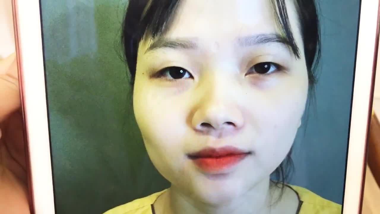 Đẹp Tự Nhiên Ngay Sau 7 Ngày Cắt Mí Mắt Tại Dr Hải Lê