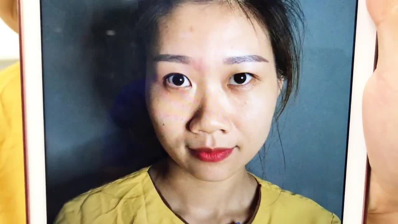 Đôi Mắt Thay Đổi Toàn Diện Chỉ Sau 30 Phút Cắt Mí Mắt Tại Dr Hải Lê
