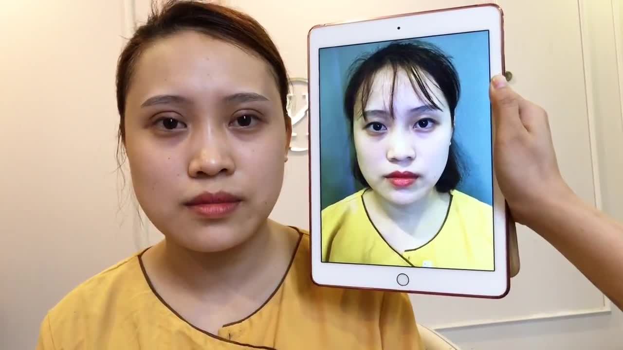 Kết Quả Cắt Mí Mắt Không Thể Hoàn Hảo Hơn Tại Dr Hải Lê - Ca 173