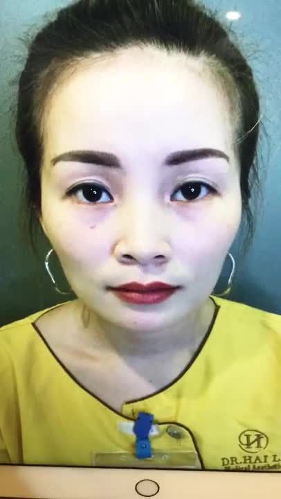 Kết Quả Cắt Mí Sụp Bằng Mani Mini Deep 5D Tại Dr Hải Lê