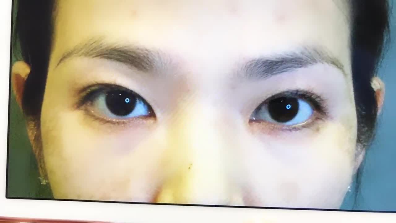 Kết Quả Vừa Cắt Mí Mani Mini Deep 5D Xong Tại Dr Hải Lê - Ca 120