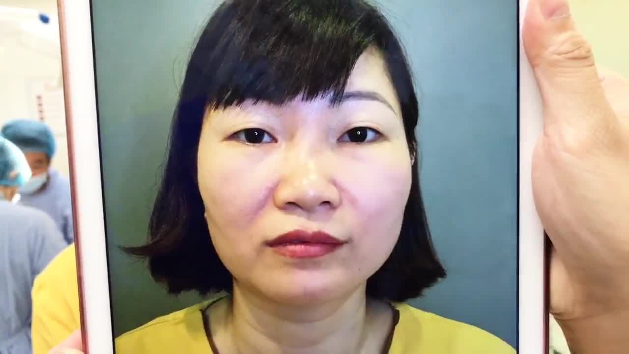 Khắc Phục Khuyết Điểm Đôi Mắt Bằng Công Nghệ Cắt Mí Mắt Tại Dr HẢi Lê - Ca 164