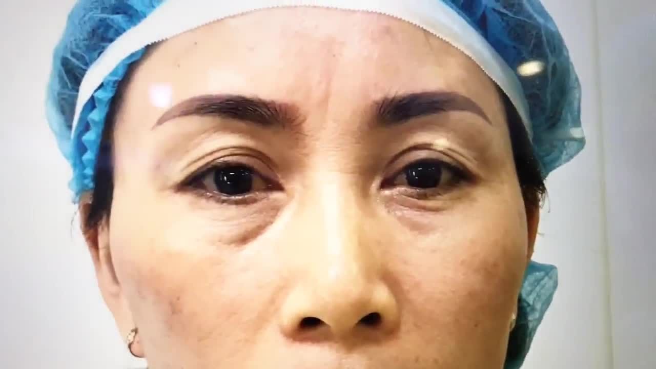 Loại Bỏ Nếp Mí Chồng Chéo Lên Nhau Bằng Kỹ Thuật Cắt Mí Mani Open Deep - Ca 247