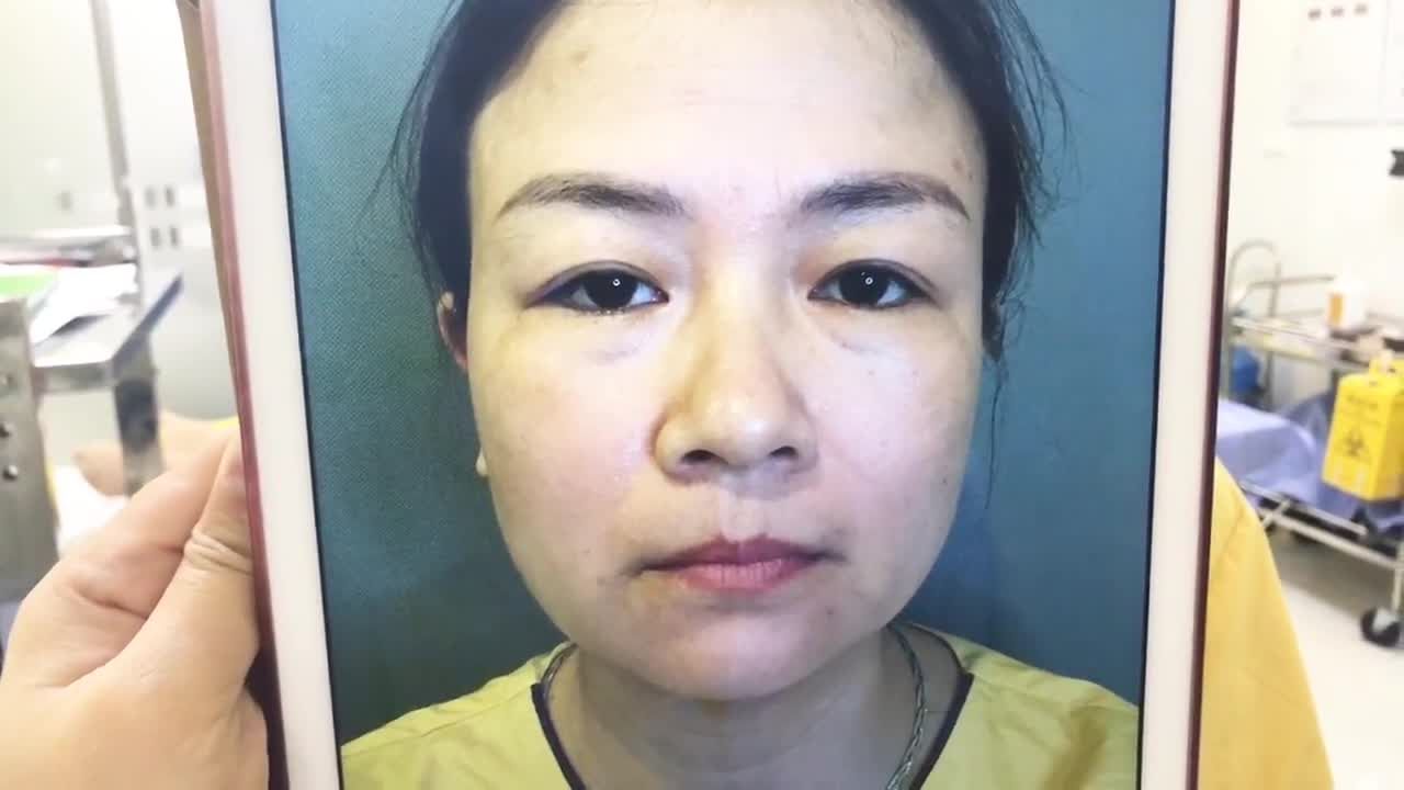 Loại Bỏ Tình Trạng Mí Sụp Do Tuổi Già Bằng Kỹ Thuật Cắt Mí Mắt - Ca 244