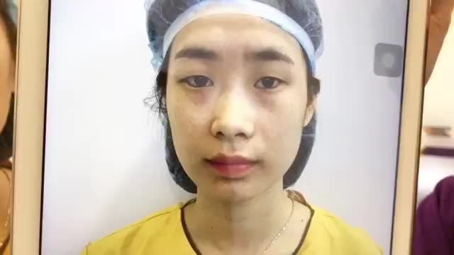 Lột Xác Cho Đôi Mắt Nhờ Cắt Mí Mắt Mani Mini Deep 5D - Ca 140