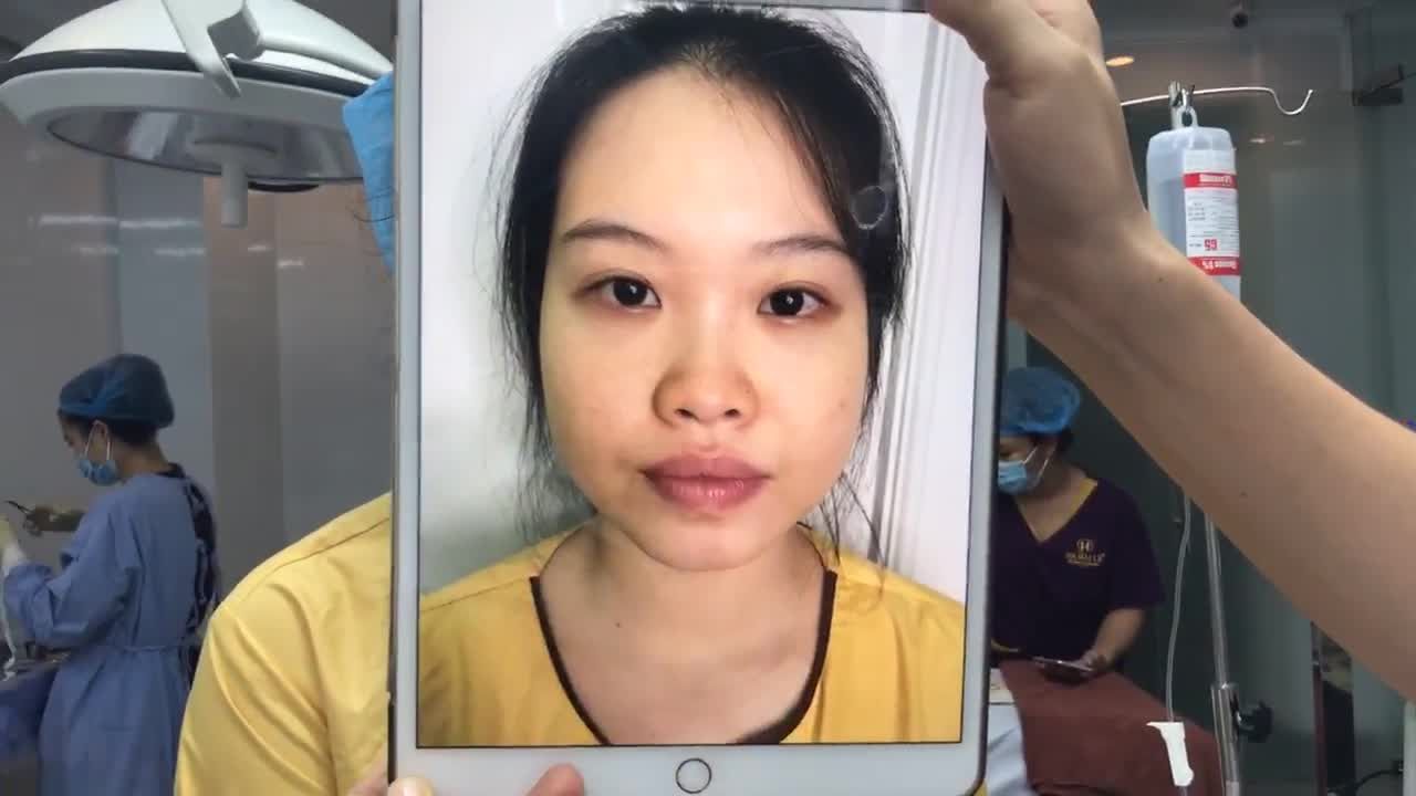 Lột Xác Sau Combo Nâng Mũi + Cắt Mí Tại Dr Hải Lê - Ca 191