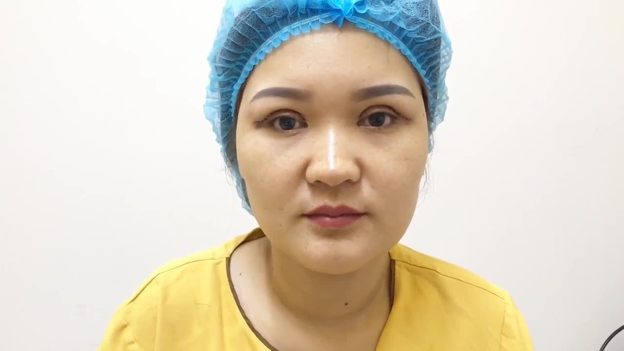 Mắt 2 Mí Rõ Rệt Sau Khi Cắt Mí Mani Open Deep 5D