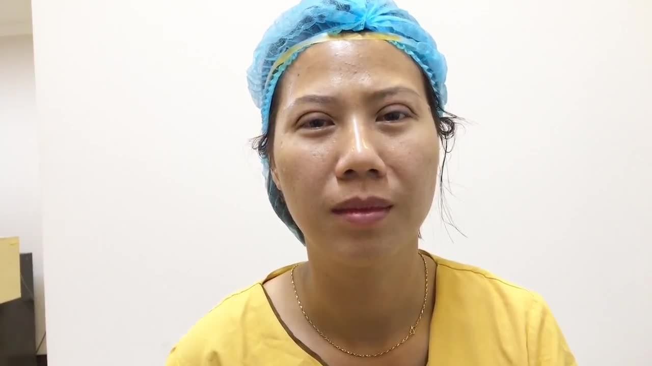 Mắt 2 Mí To Rõ Tự Nhiên Sau Khi Vừa Cắt Mí Mắt Tại Dr Hải Lê - Ca 152