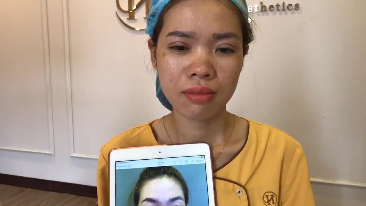 Mắt Đẹp Tự Nhiên Đến Kinh Ngạc Ngay Sau 45 Phút Cắt Mí Mắt Tại Dr Hải Lê - Ca 179