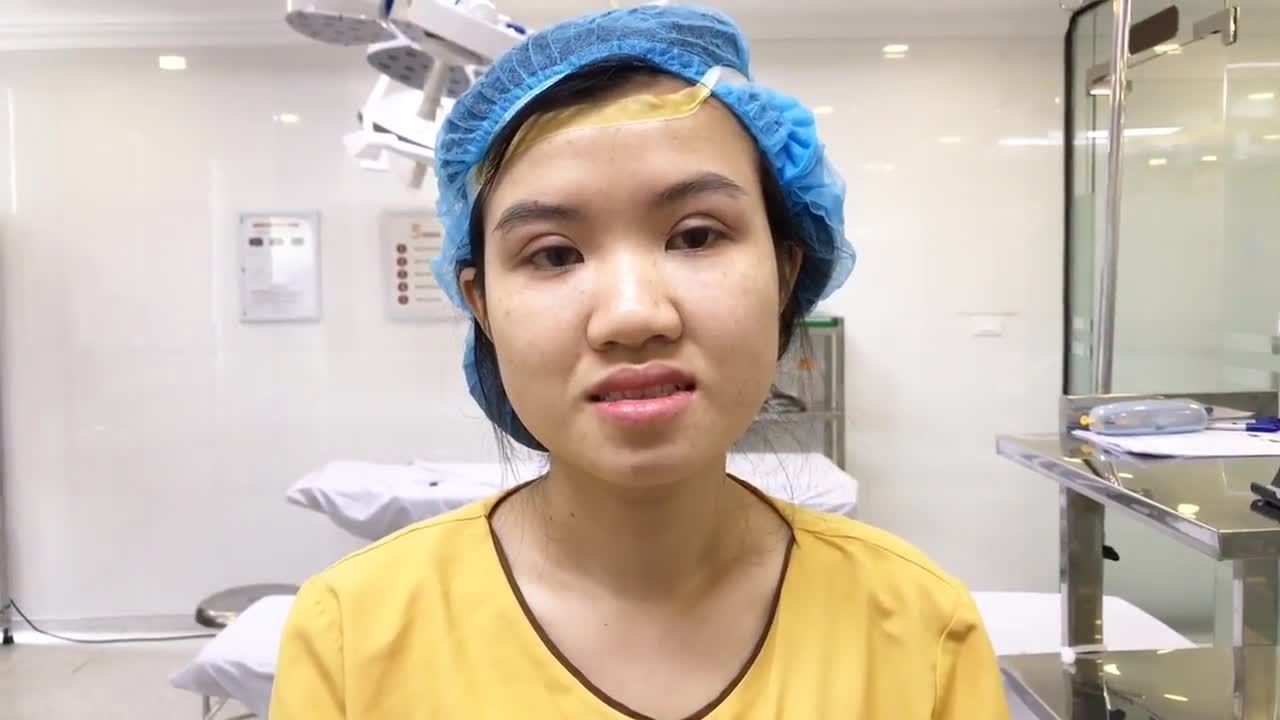 Mắt Đẹp Tự Nhiên Ngay Sau Khi Vừa Cắt Mí Xong Tại Dr.Hải Lê - Ca 157