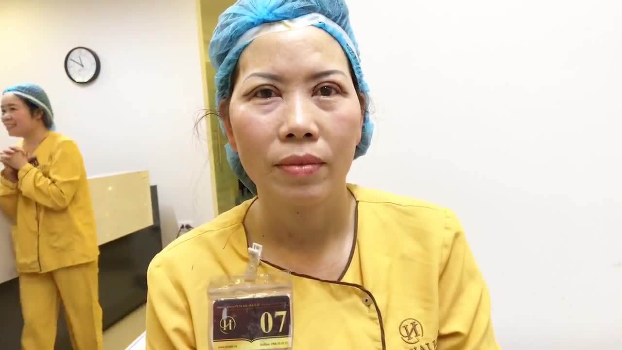 Mắt To Mí Tròn Chỉ Sau 30 Phút Cắt Mí Mắt Sụp Tại Dr Hải Lê - Ca 116