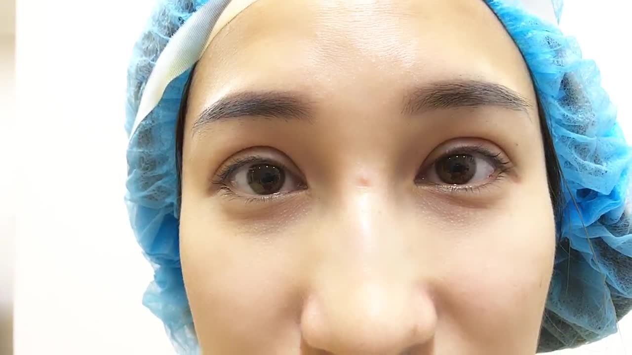 Mí Đẹp Tuyệt Vời Chỉ Sau 45 Phút Cắt Mí Mani Mini Deep 5D - Ca 210