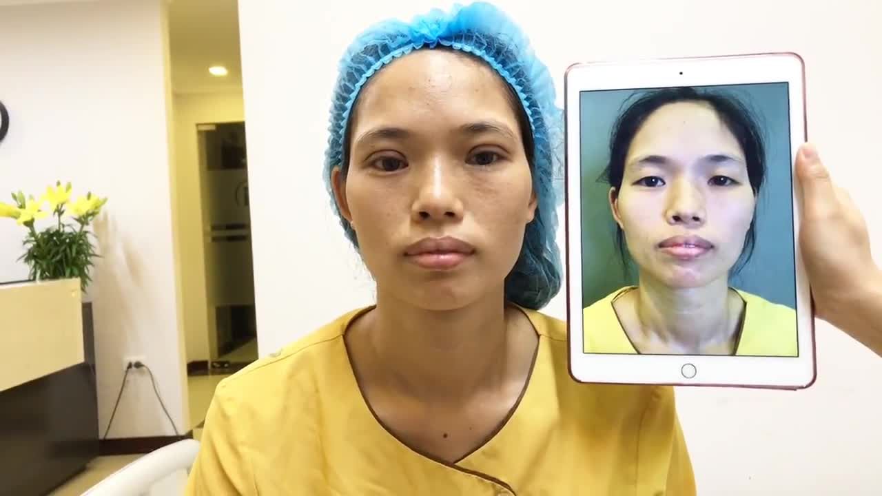 Mí Đều Hoàn Hảo Sau Cắt Mí Mani Mini Deep 5D - Ca 170