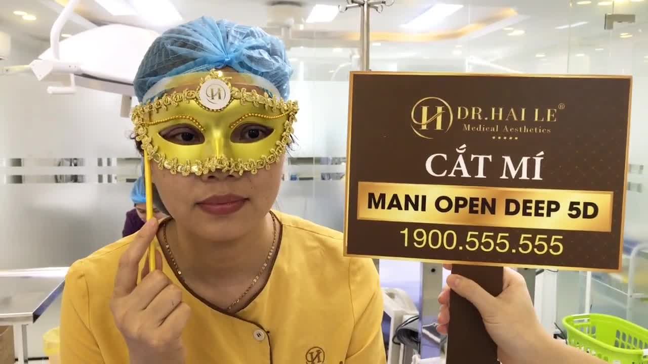 Một ca cắt mí Mani OPen Deep đẹp đến từng centimet