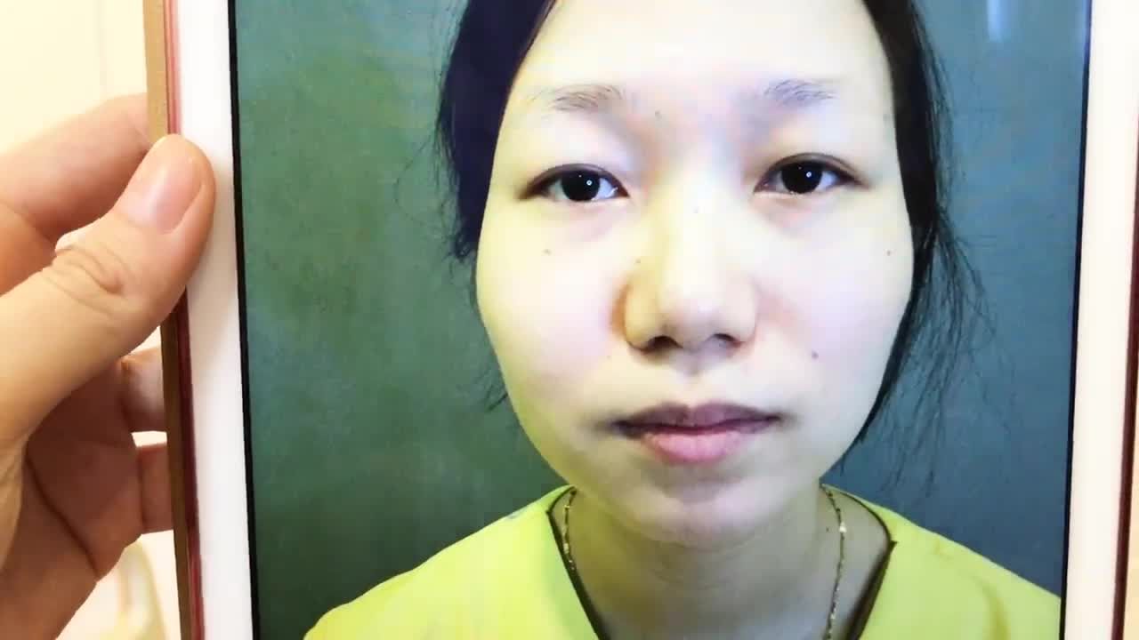 Nếp Mí Sau 7 Ngày Cắt Mí Mắt Mani Mini Deep 5D