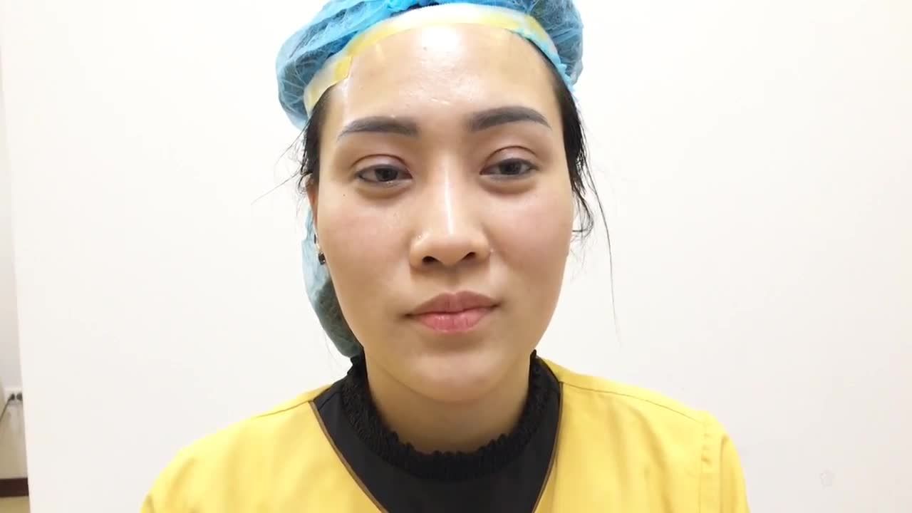 Phù Phép Đôi Mắt 2 Mí Bằng Công Nghệ Cắt Mí Mắt Tại Dr Hải Lê - Ca 136