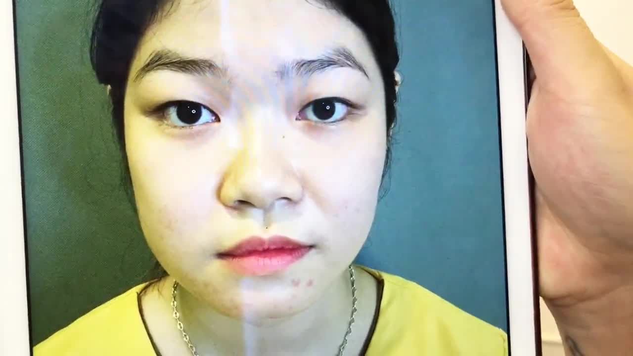 Sự Thay Đổi Đánh Kinh Ngạc Giữa Trước Và Sau Cắt Mí Mắt Tại Dr Hải Lê - Ca 242